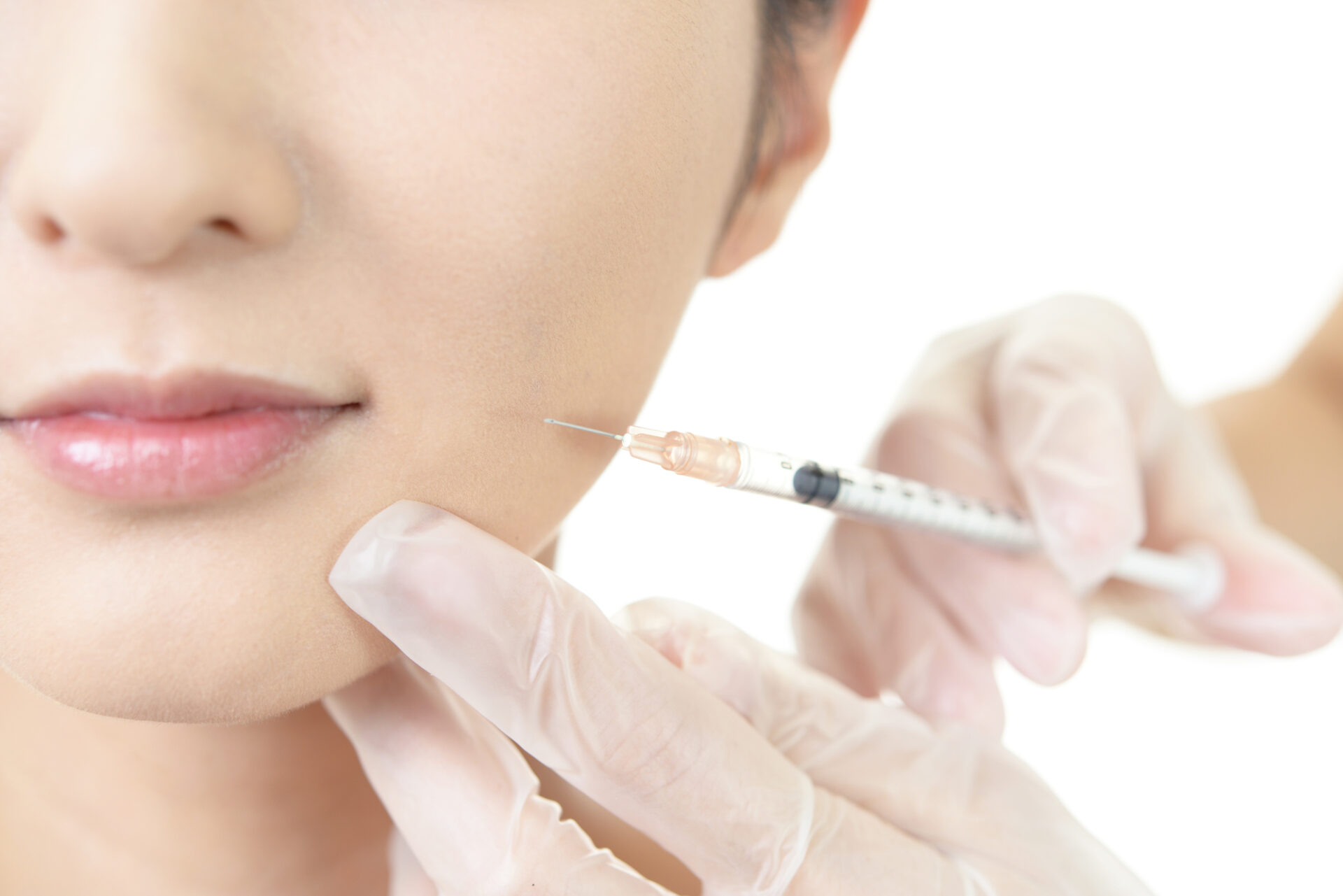 ヒアルロン酸注入の施術画像